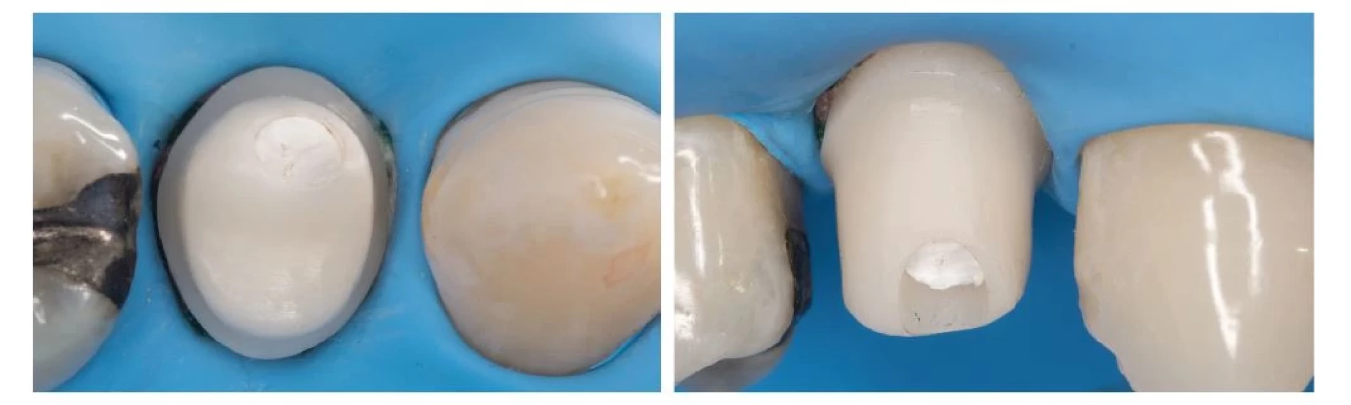 Fixácia korunky na implantát
s použitím kofferdamu
a individálne zhotoveného
ZrO abutmentu.<br>
Fig. 7
Fixation of implant crown
using rubber dam and custommade
zirconia abutment.