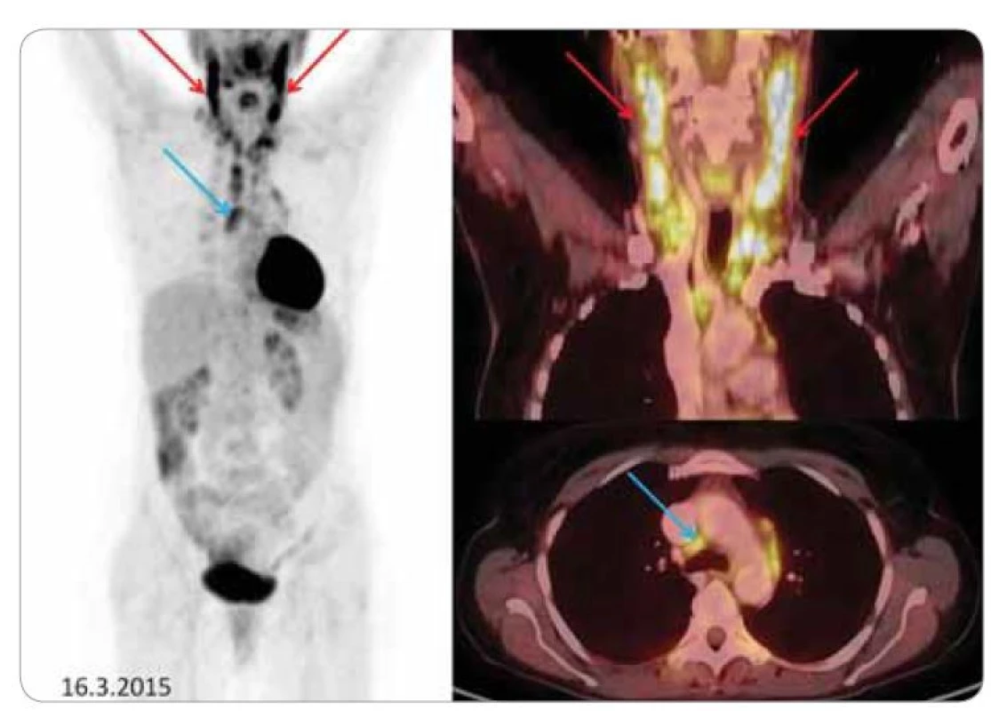 Vstupní PET CT.