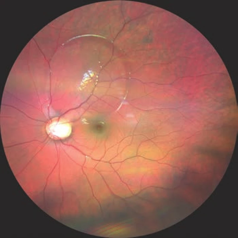 Photograph of fundus of left eye, ODP with serous
ablation of neuroretina superotemporally