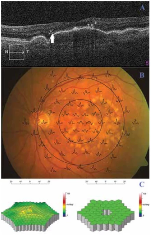 Oftalmologický nález pacientky před rheoferézou.
(A) Optická koherenční tomografie levého oka nemocné před
rheoferézou. Od rozsáhlé drúzové ablace retinálního pigmentového
epitelu se začíná odchlipovat tenká vrstvička elipsoidů fotoreceptorů
(šipka). (B) Superpozice mfERG odpovědi na fundu
levého oka pacientky. (C) Trojrozměrný obraz mfERG. Vlevo trojrozměrný
obraz elektrické aktivity sítnice levého oka nemocné;
vpravo porovnání s věkovou normou (pokles aktivity foveolární
a parafoveolárních odpovědí)