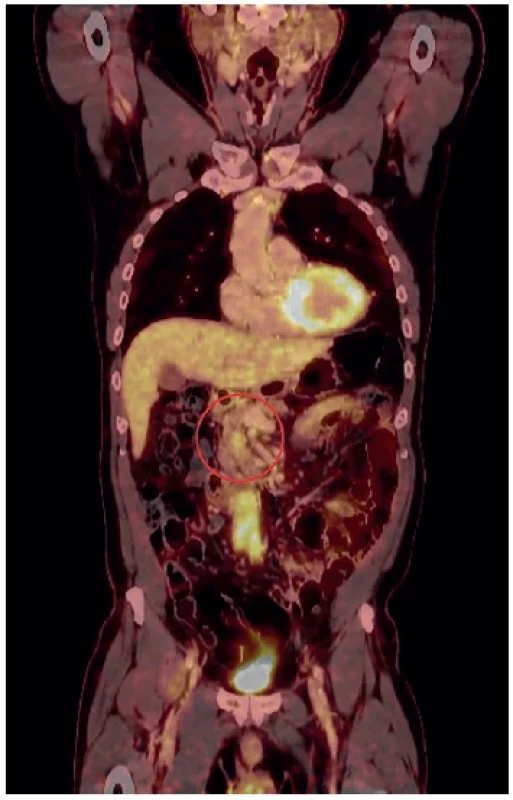 PETCT s ložiskem akumulace 18F-FDG v hlavě pankreatu <br> 
Fig. 5. PETCT with accumulation of 18F-FDG in head of
pancreas