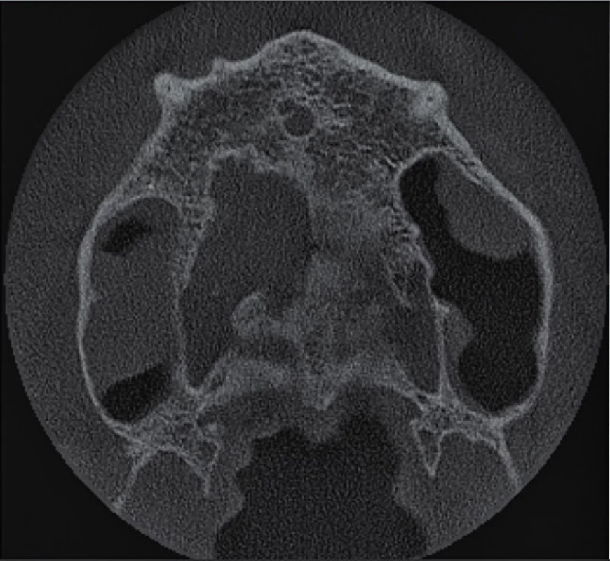 Horizontální řez
CBCT snímku nad hroty
kořenů horních středních
řezáků. Není přítomno periapikální
projasnění
u zubu 11