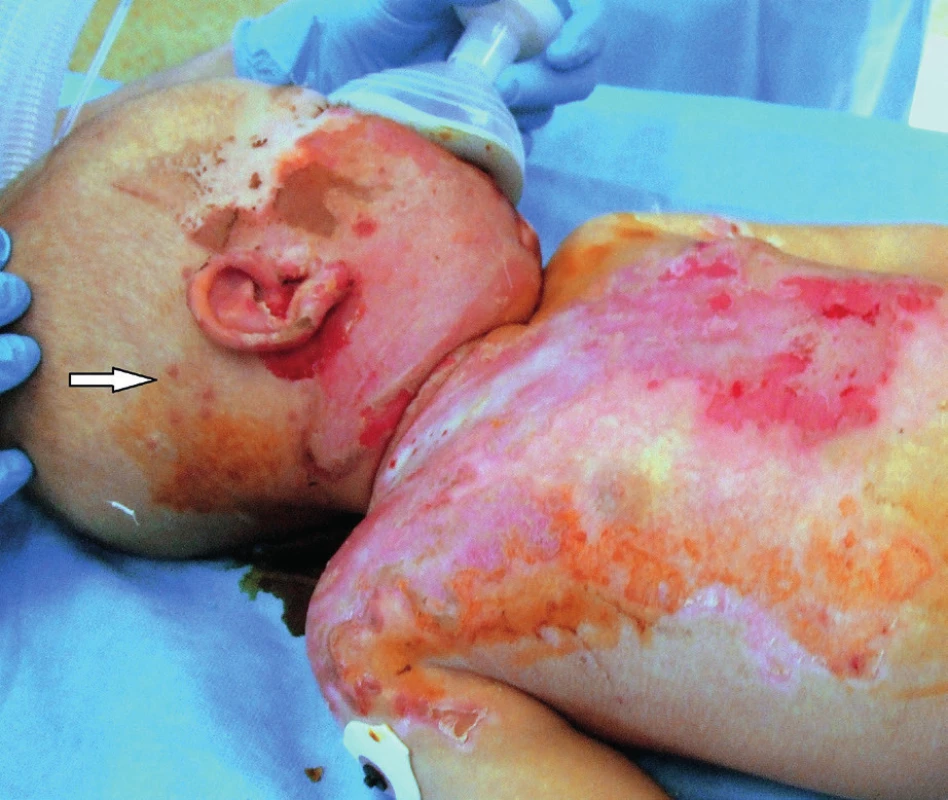 Post-burn day 12: Macular–vesicular herpetic rash
appeared on the edges of the burn wound (arrow)