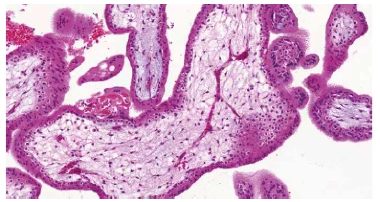 Trizomie chromozomu 21. Nepravidelně větvené kapiláry s fetálními
erytroblasty v luminu (HE, 200x).