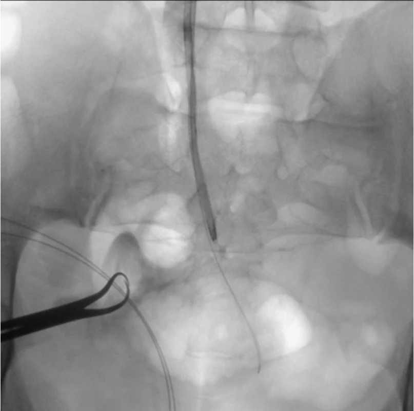 Antegrádní pasáž flexibilního ureteroskopu
ke konkrementu na skiaskopii (označen šipkou)<br>
Fig. 3. Antegrade passing of flexible ureteroscope to
the stone (an arrow showing the stone)