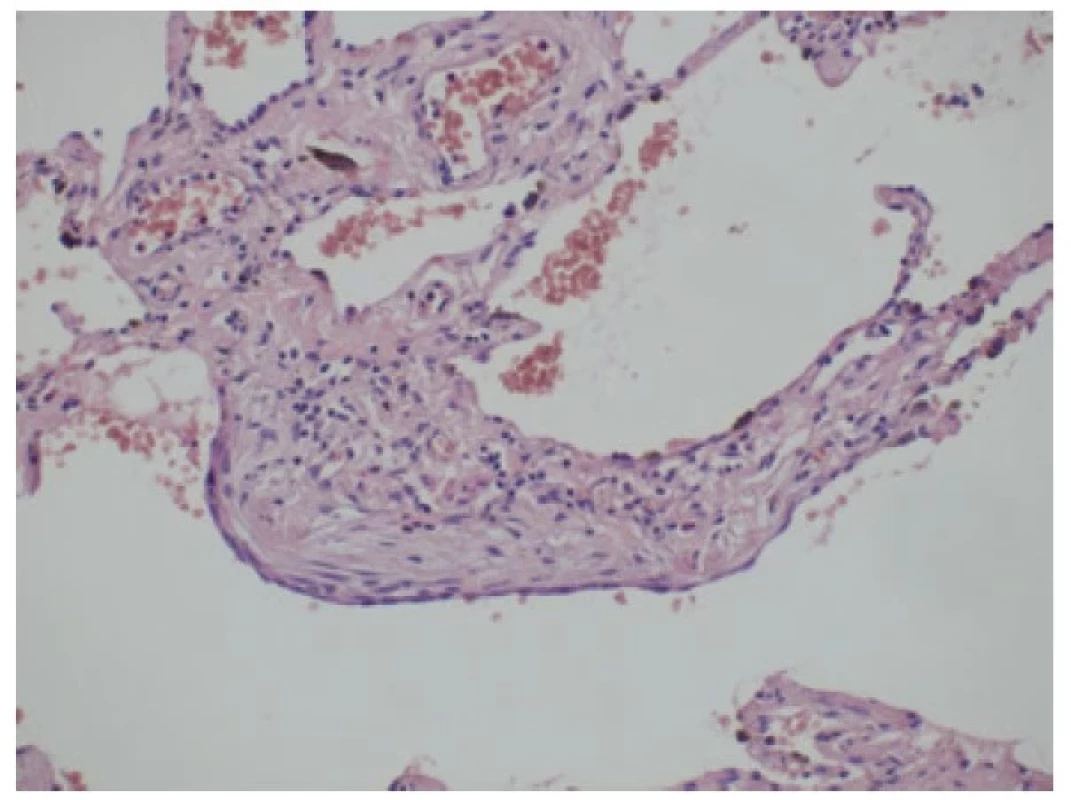 Fibroblastický fokus (původní zvětšení 400x).