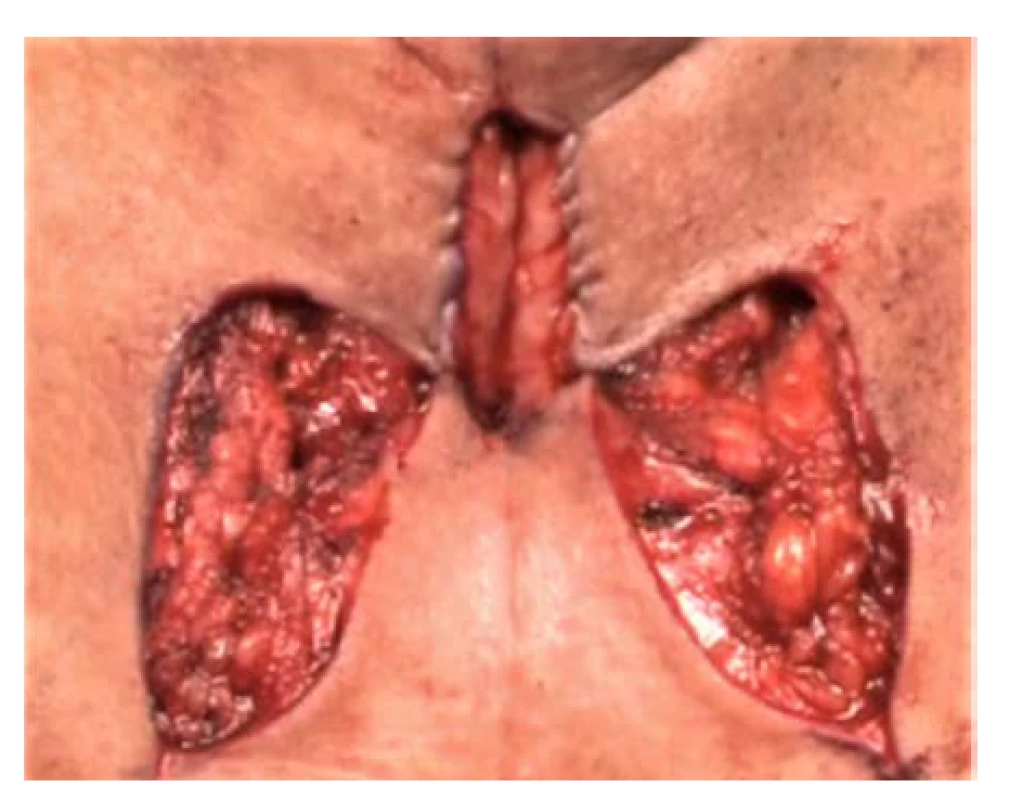Perineální uretrostomie dle Blandyho<br>
Fig. 2. Perineal urethrostomy according to Blandy