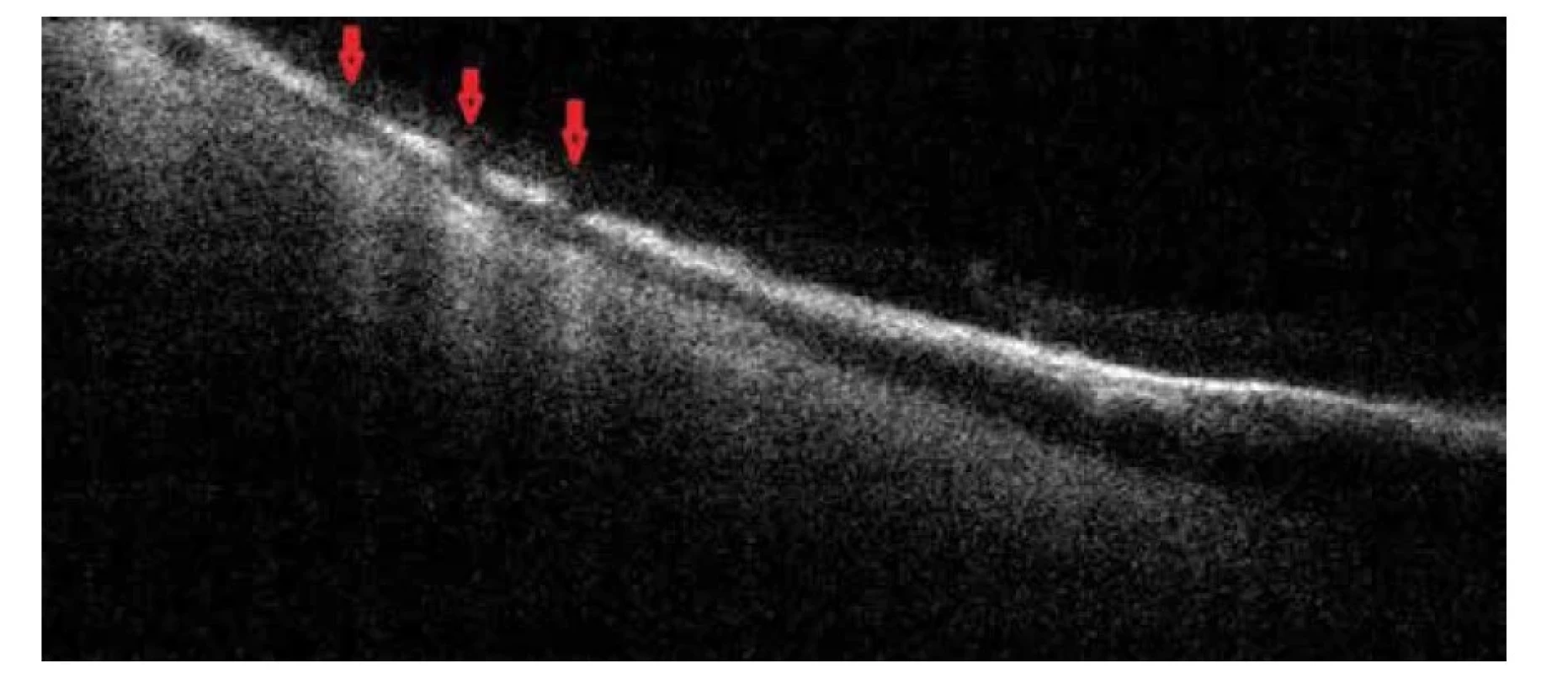 Kontrolní OCT zobrazení periferní sítnice po laserovém ošetření pacienta 10. Červené šipky dokumentují
window defekty v místech fotokoagulace