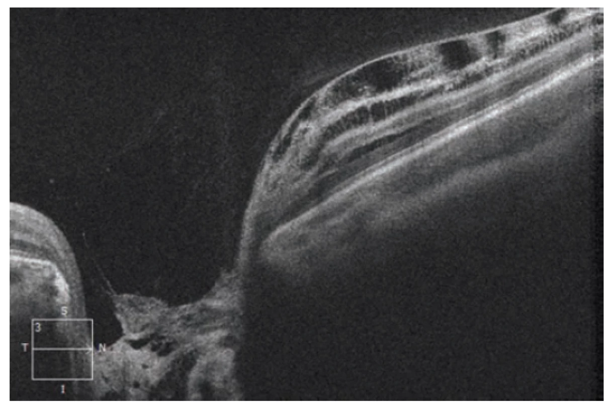 HD-OCT: Lineární horizontrální transpapilární
sken pravého oka, rozsáhlá JTZN překryta hyperreflektivní
tkání. Nasálně obraz schisis-like retinopatie se separací
jednotlivých retinálních vrstev