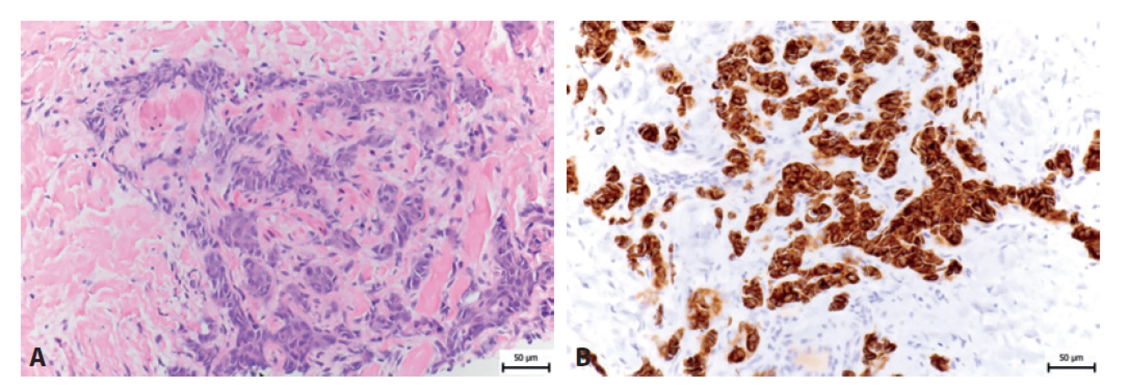 A: HE 26letého pacienta s Ewingovým sarkomem. B: Imunohistochemický průkaz cytokeratinu-KL1.