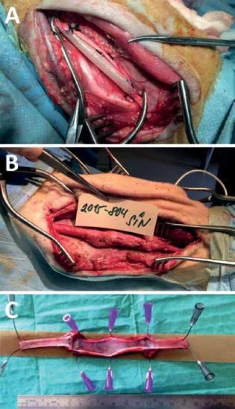 Fotografie cévní náhrady
Cévní náhrada po implantaci (A), s 6 měsíčním odstupem při
reoperaci (B) a explantovaná průchodná náhrada s patrným
omezením průtoku za distální anastomózou (C)<br>
Fig.1: Perioperative photo of implanted graft
Perioperative photo of implanted graft (A), 6 months later (B)
and explanted graft with no thrombi (C).