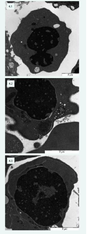 Změny typické pro CDA v elektronovém
mikroskopu – pacientka s CDA IV: 4.1 – jaderný
můstek v erytroblastu a defekty chromatinu
(„spongychromatin“) 4.2 – „spongychromatin“,
atypické lamelární tělísko, siderosom
4.3 – intermediární atypická cisterna v erytroblastu