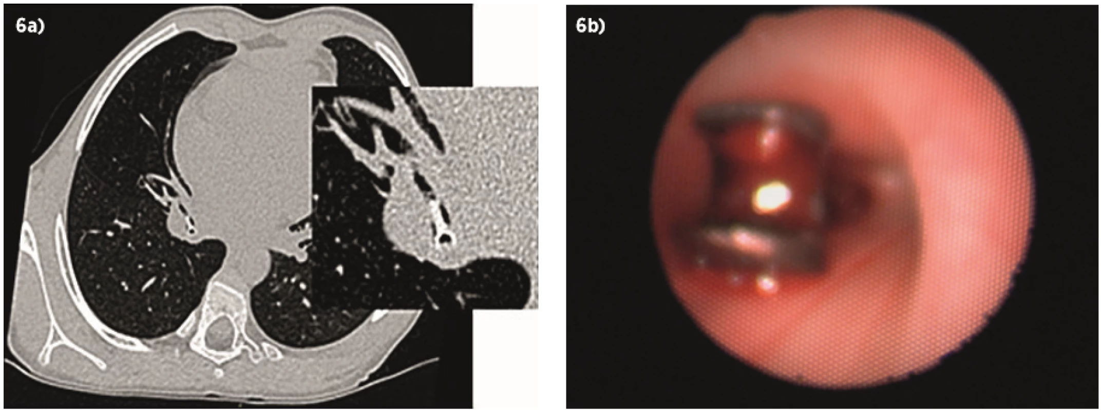 Anorganické cudzie teleso (LEGO ručička): a) v CT obraze uložené v bronchus intermedius vpravo, b) v endoskopickom obraze. <br>Fig. 6.  An anorganic foreign body (a LEGO hand): a) in a CT image found in the right intermedius bronchus, b) in an endoscopic image.