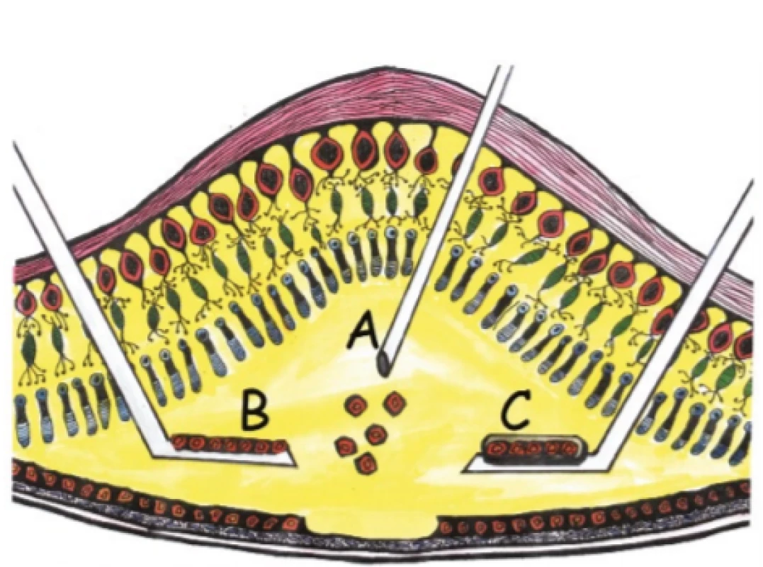 Surgical technique of retinal pigment epithelium
transplantation. Application of cellular suspension (A), self- -supporting cell plate (B), cell plate on artificial supporting
carrier (C)