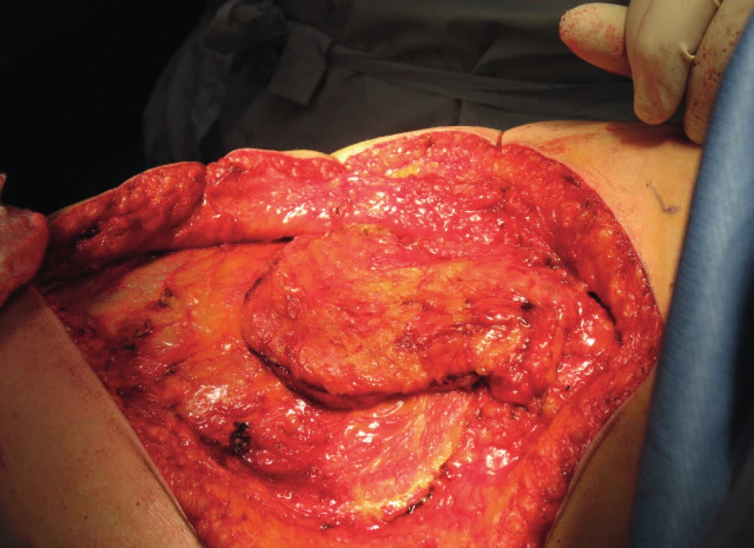 Dissection of the serratus anterior muscle