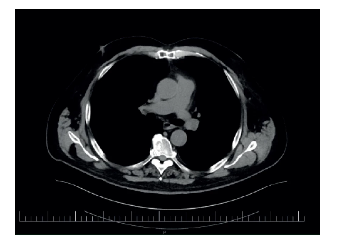 Pooperačný stav – pľúcnica bez trombu<br>
Fig. 9: Postoperative condition – pulmonary artery without
the thrombus