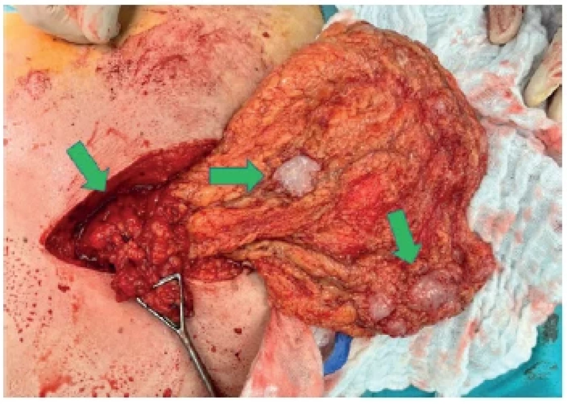 Peroperační nález
Omentum poseto metastázami (zelené šipky). <br> 
Fig. 1. Intraoperative finding
Omentum covered with metastases (green arrows).
