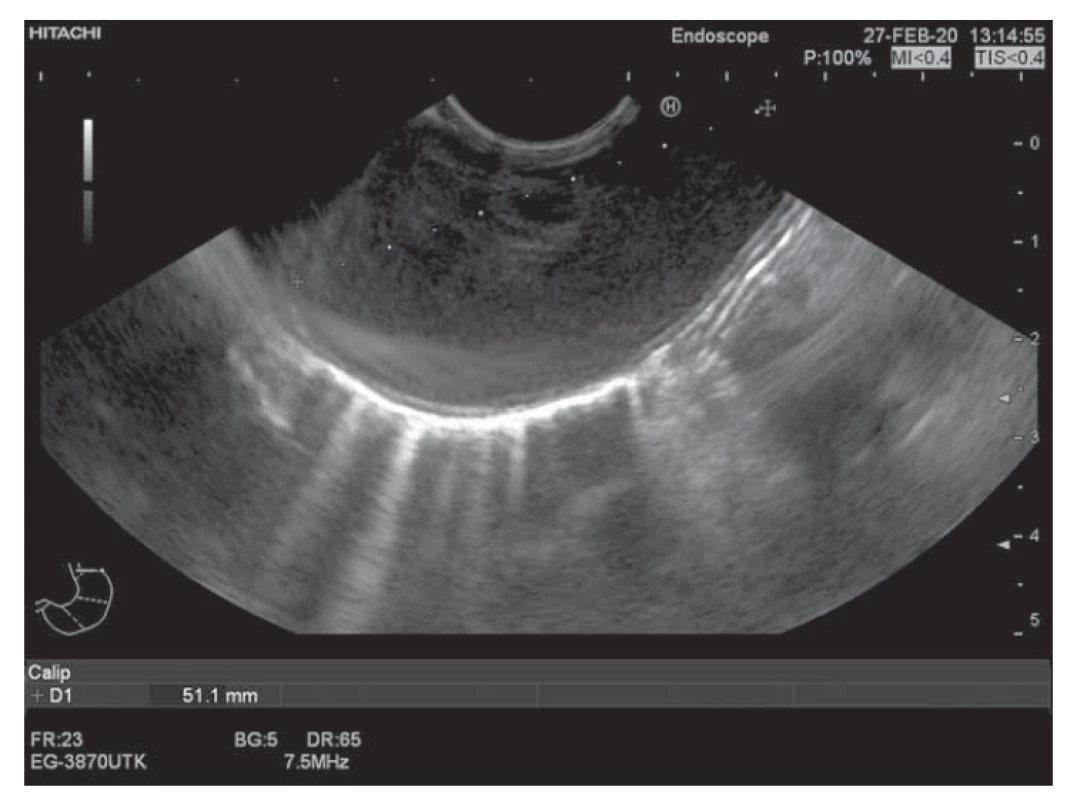 Duplikačná cysta ezofágu: EUS obraz.<br>
Fig. 2. Duplicative esophageal cyst: EUS image.
