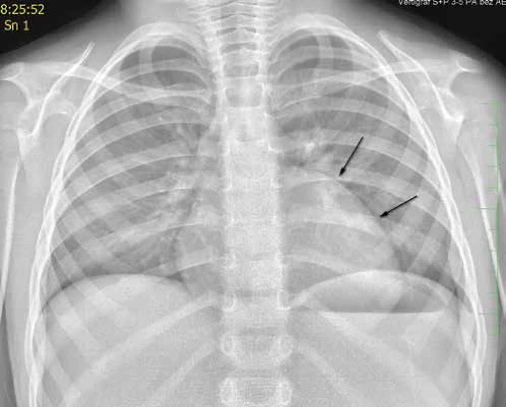 Rentgenové vyšetření hrudníku u fibromu levé komory, kardiomegalie a změna srdeční
kontury.<br>
Fig. 1. Chest X-ray examination, left ventricular fibroma, cardiomegaly, and change of heart
contour.