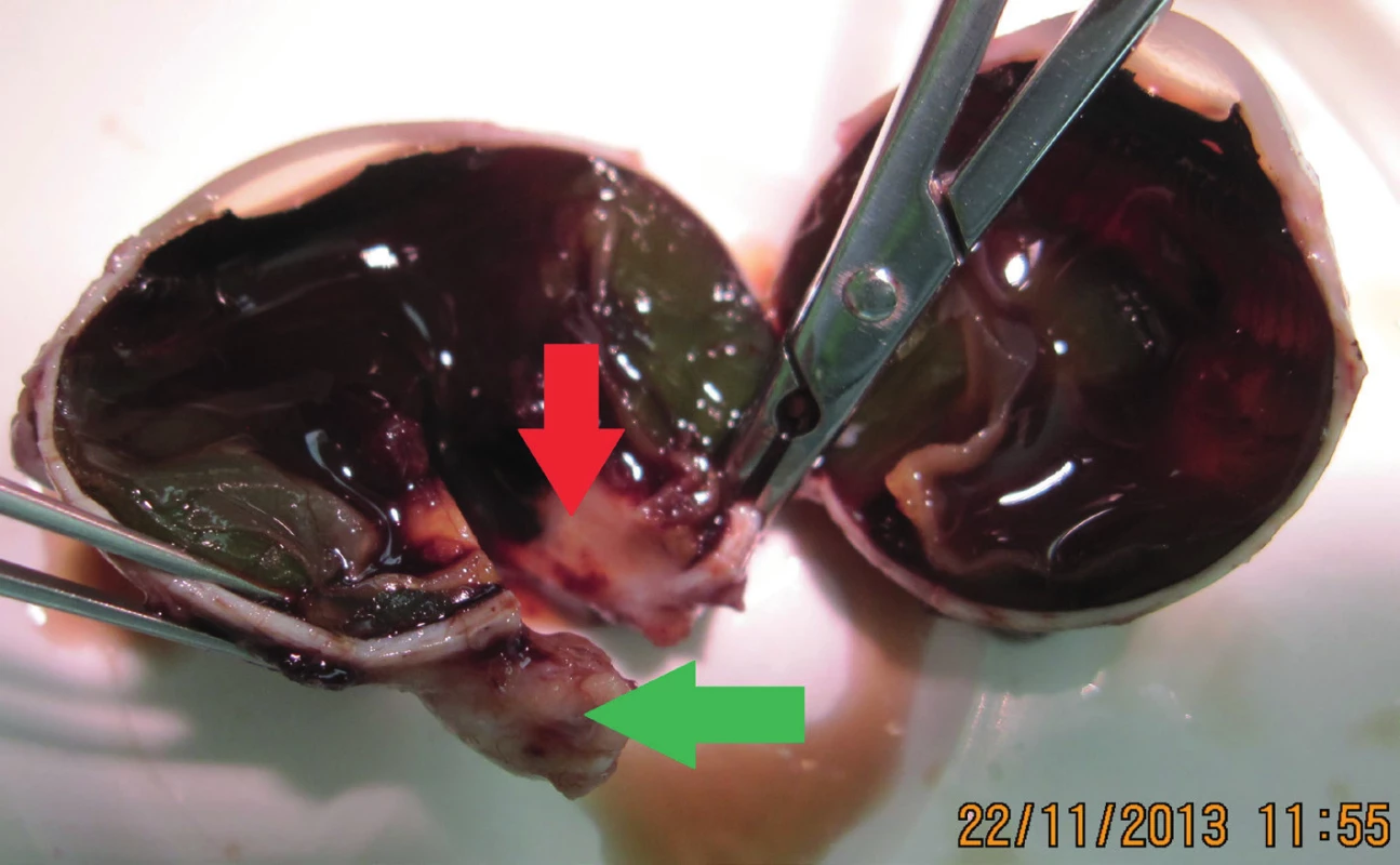 Eyeball after enucleation – red arrow indicates tumour deposit and green
arrow disc of optic nerve
