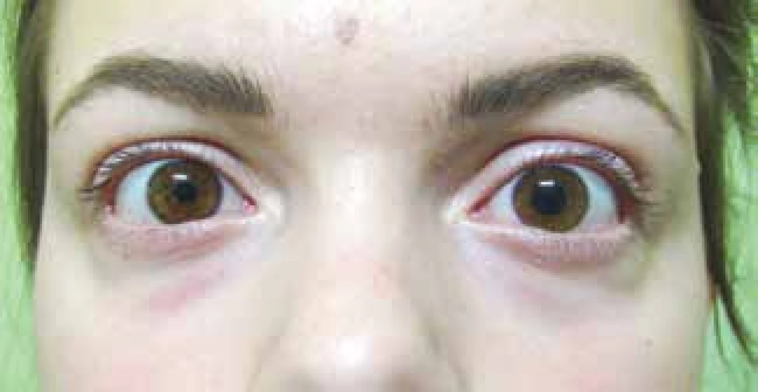 Negative result of pharmacological test with
application of 0.1% Pilocarpine in left eye