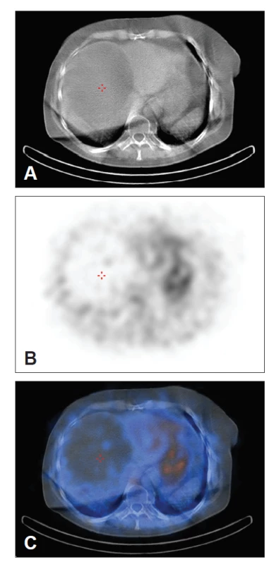 Hybridní zobrazení SPECT/ low dose CT (A – CT obraz,
B – SPECT obraz, C – fúze obou obrazů). Na transverzálním CT
řezu je patrné kulaté hypodenzní ložisko v játrech korespondující
s fotopenickou oblastí na transverzálním SPECT řezu.