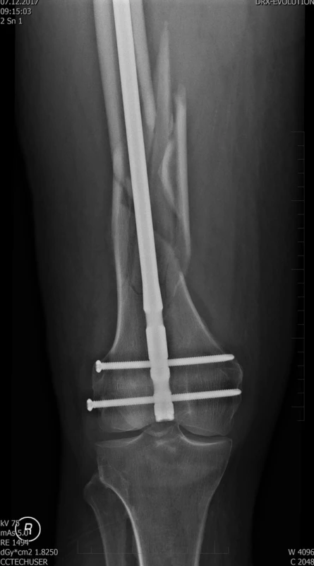 Pooperační rtg stehenní kosti vpravo
– stav po nitrodřeňové osteosyntéze femuru