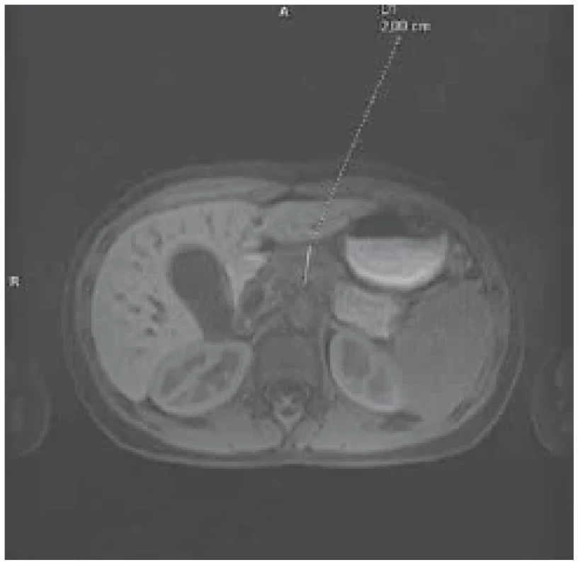 Změněný signál na MR těla pankreatu
s jeho lehkým rozšířením, mírné
rozšíření pankreatického vývodu. <br> 
Fig. 3. Changed signal on MRI of the body
of the pancreas with its slight expansion,
slight expansion of the pancreatic duct.