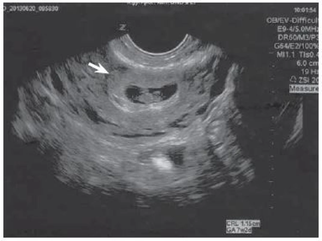 Rast gravidity do jazvy po cisárskom reze, zodpovedajúci 7+2 týždňu tehotenstva (šípka), foto autori. </br> Growth of pregnancy into the scar after a caesarean
section corresponding to 7+2 weeks of pregnancy (arrow), photo by the authors.