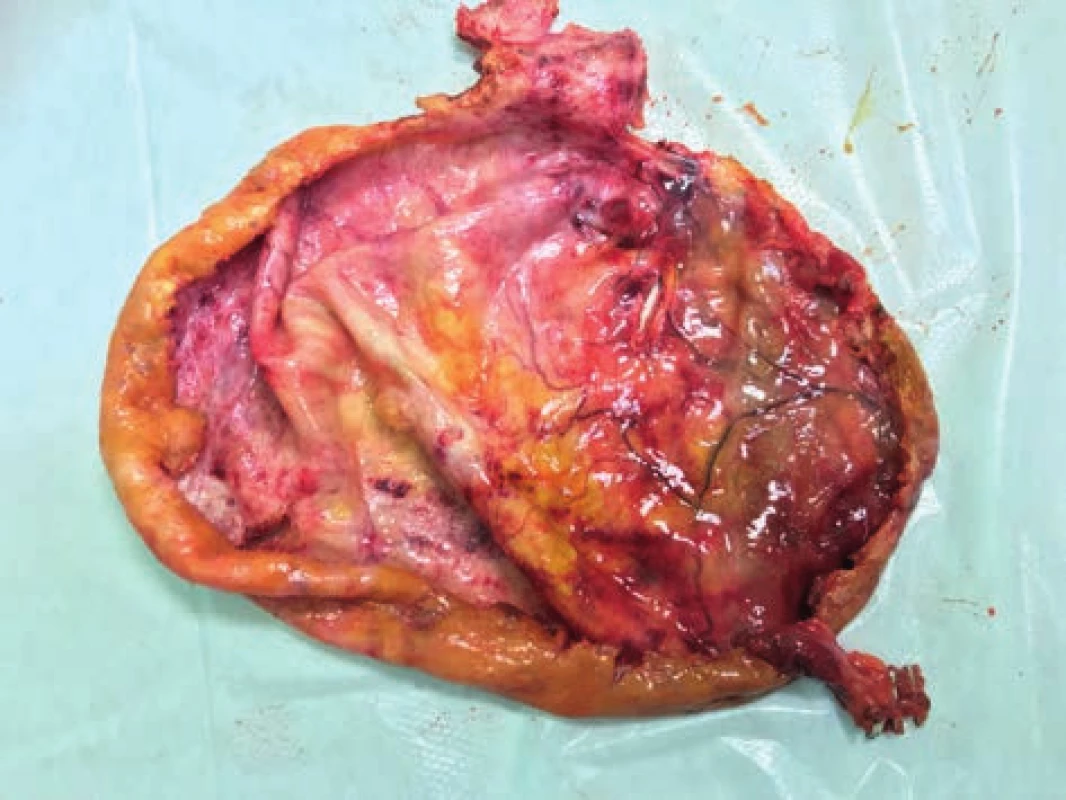 Stěna cysty en-block se žlučníkem<br>
Fig. 1: The wall of a liver cyst en-block with the gallbladder