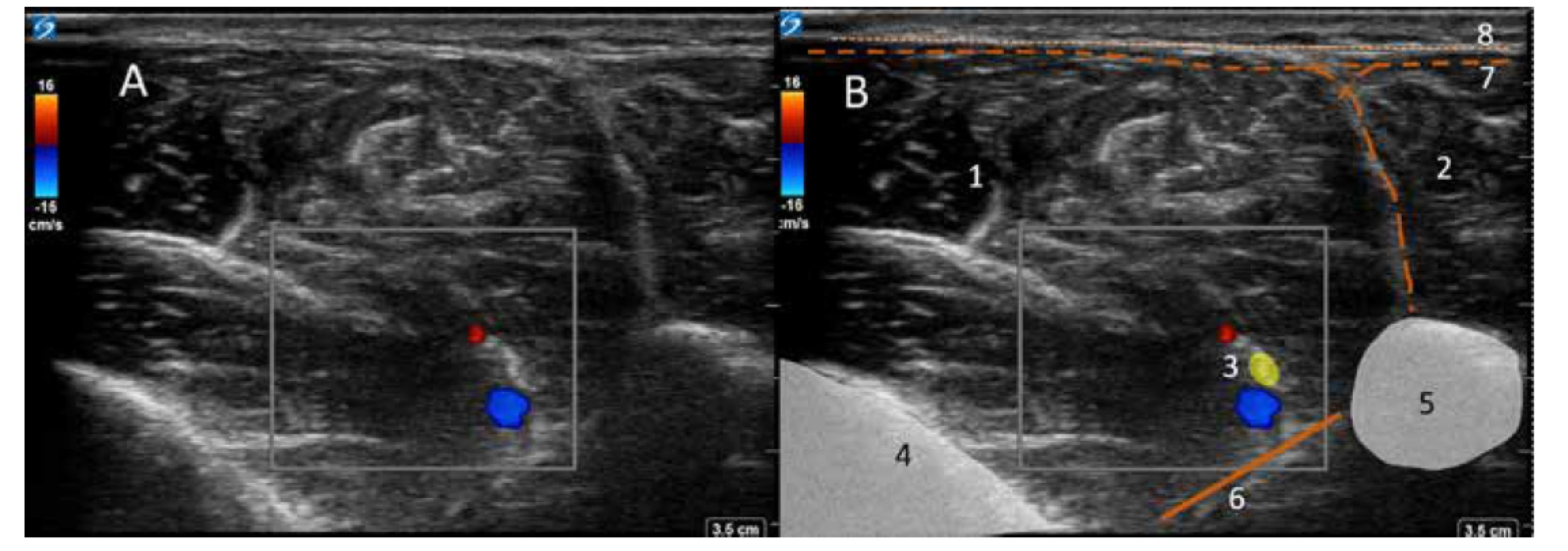 Nervus peroneus profundus na rozhraní střední a dolní třetiny bérce. Ultrazvukový obraz Color Doppler. A. color Doppler obraz. B. kolorovaný obraz:
1. přední kompartment, 2. laterální kompartment, 3. neurovaskulární svazek, 4. tibie, 5. fibula, 6. ligamentum interosseum, 7. hluboká fascie, 8. povrchní fascie