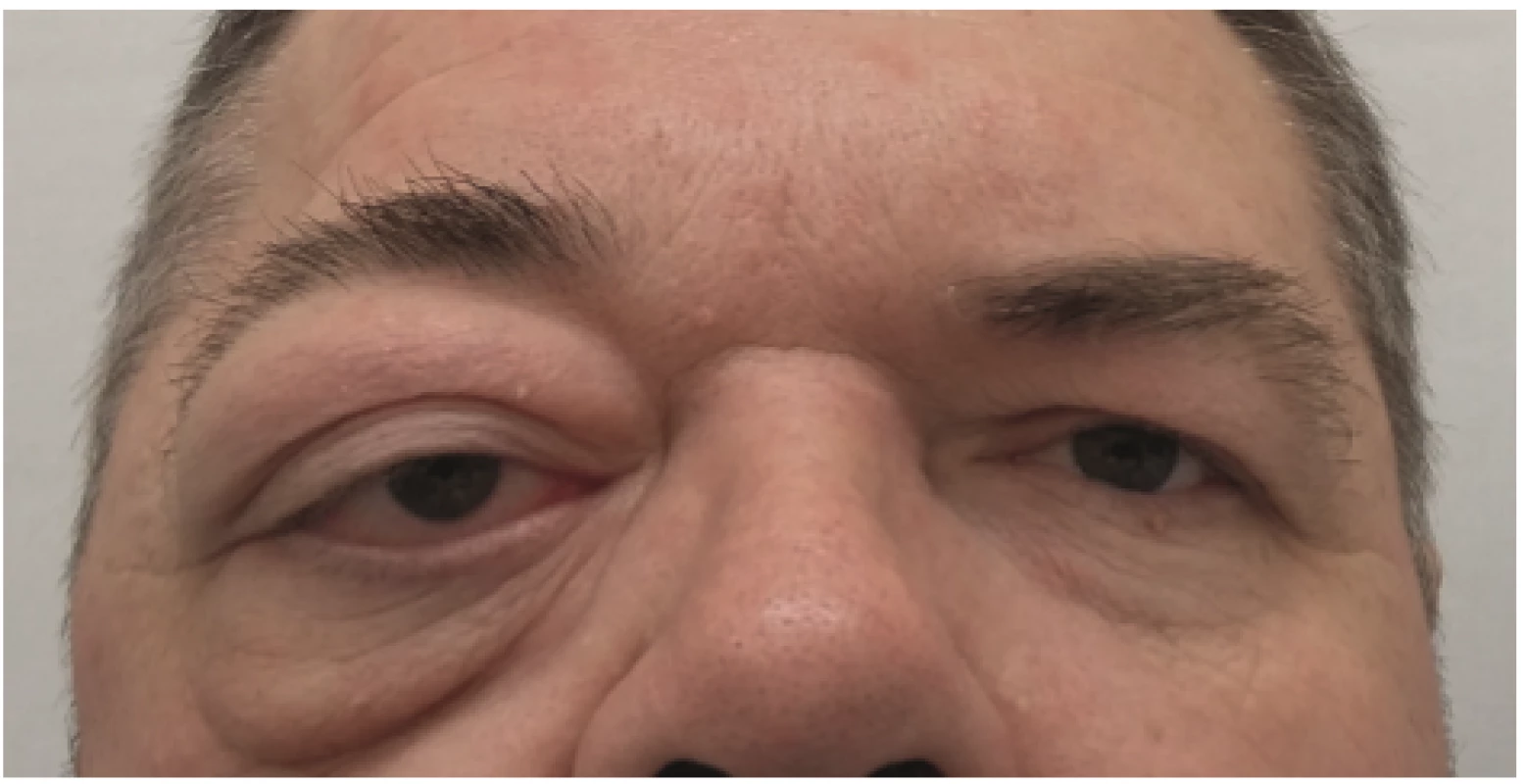 Axial exophthalmos, baggy swellings of the eyelids and bulging of the temple area in the case of pterional meningeoma in right eye 
