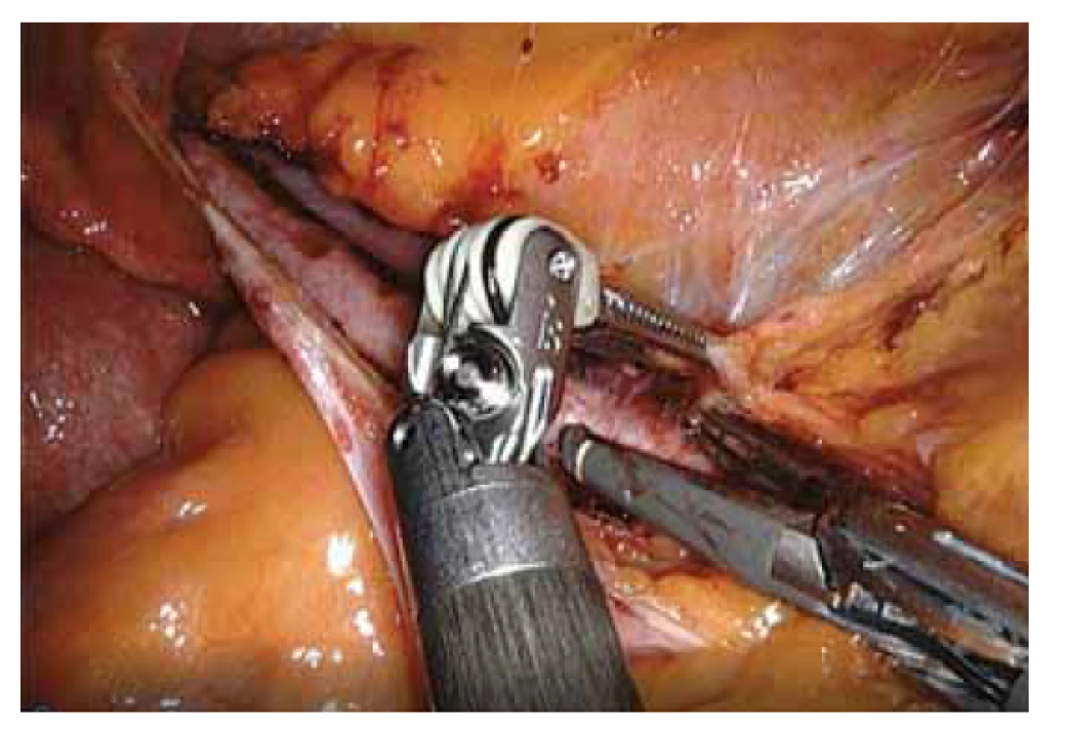 Ilustrační foto z pánevní robotem asistované laparoskopické
lymfadenektomie s využitím Vessel sealeru.<br>
Fig. 2. Illustration photo from pelvic robot-assisted laparoscopic
lymphadenectomy using a Vessel sealer.