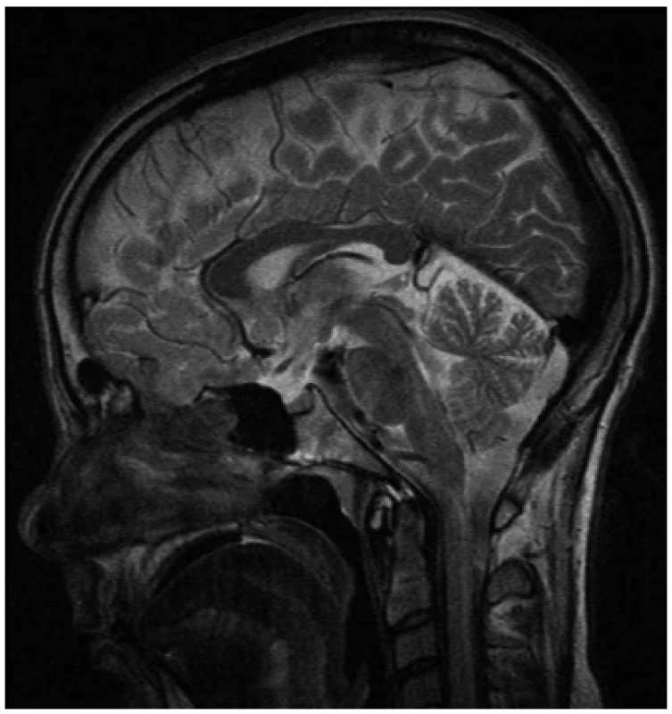 Magnetická rezonance mozku – normální nález na hypofýze <br> 
Fig. 1. Magnetic resonance imaging of the brain – normal findings on the pituitary gland