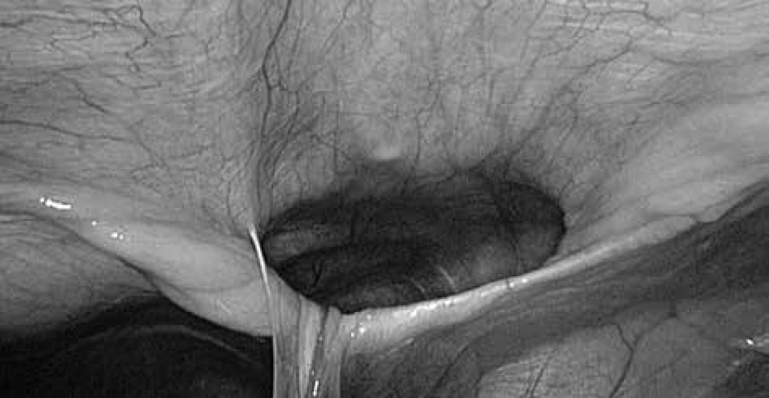 Morgagniho kýla při laparoskopii, ligamentum teres hepatis vtaženo do defektu v bránici<br>
Fig. 5: Laparoscopical view of Morgagni hernia, ligamentum teres hepatis in the diaphragmatic defect 