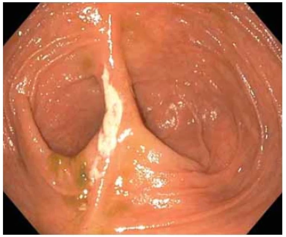 Kontrolní pouchoskopie květnu 2021. <br> 
Fig. 1. Control pouchoscopy in May 2021.