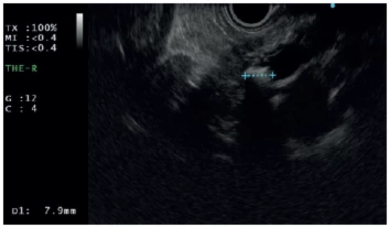 Endoscopic ultrasound showing an 8mm pancreatic
duct stone in a patient with chronic pancreatitis and
main pancreatic duct stricture