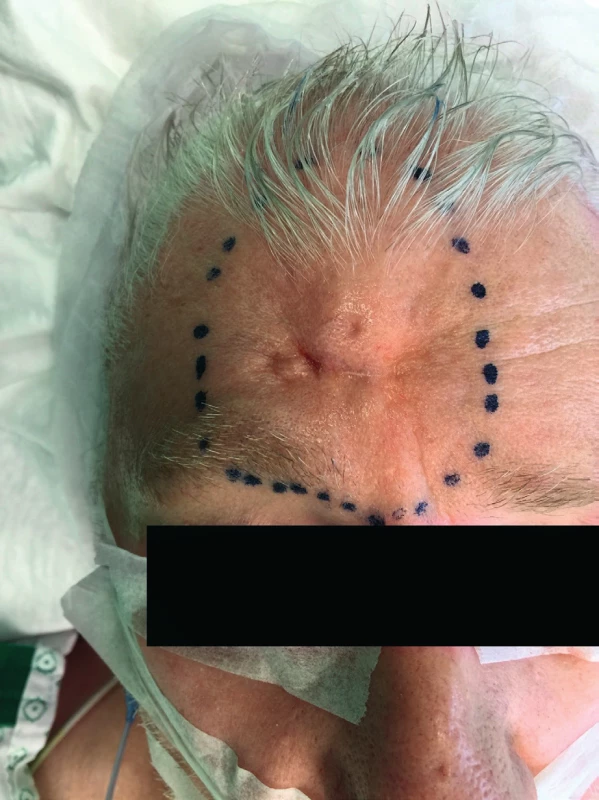 Preoperative state, large indurated lesion in the right
frontal area of the forehead