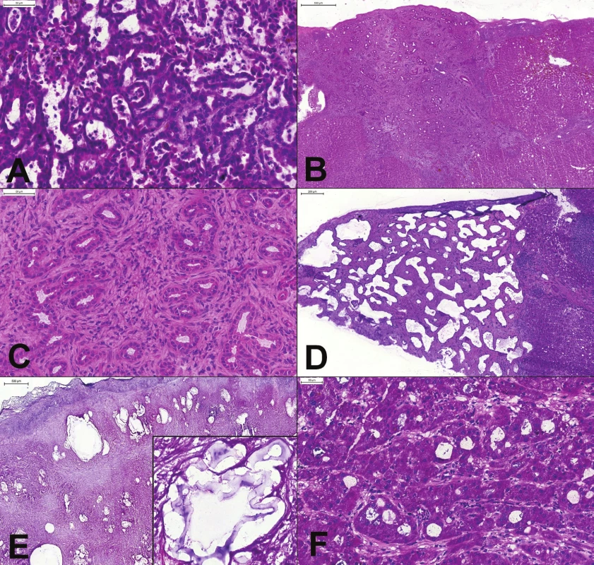 (A) Metastáza adenokarcinómu choledochu v pečeni. Až po vylúčení metastatického origa by mohol tumor byť považovaný
za primárny intrahepatický cholangiokarcinóm. (B, C) Subkapsulárne ložisko u pacienta so suspektným tumorom
žalúdka. Ostro ohraničené ložisko, tvorené pravidelnými žliazkami v kolagénnej stróme s lymfocytmi, bez mitóz a cytologických
atypií. Peroperačná a definitívna biopsia: biliárny adenóm. (D) Subkapsulárne ložisko u pacienta s karcinómom žalúdka.
Nepravidelne anastomozujúce cysticky dilatované priestory vystlané blandným plochým až kubickým biliárnym epitelom.
Peroperačná a definitívna diagnóza: biliárny hamartóm (von Meyenburg complex). (E) Tumor pečene u 55-ročného muža.
Mikroskopicky zachytené výrazné fibroproduktívne zmeny s mnohopočetnými cystickými štruktúrami. Vo veľkom zväčšení
(vložený obrázok) charakteristická laminárna membrána. Peroperačná a definitívna diagnóza: alveolárna echinokokóza. (F) Tumor
pečene u 60-ročného muža. Aj keď sú nádorové bunky cytologicky relatívne málo atypické, architektonika (široké trámce
a pseudoglandulárne formácie) umožňujú spoľahlivú peroperačnú diagnózu hepatocelulárneho karcinómu.