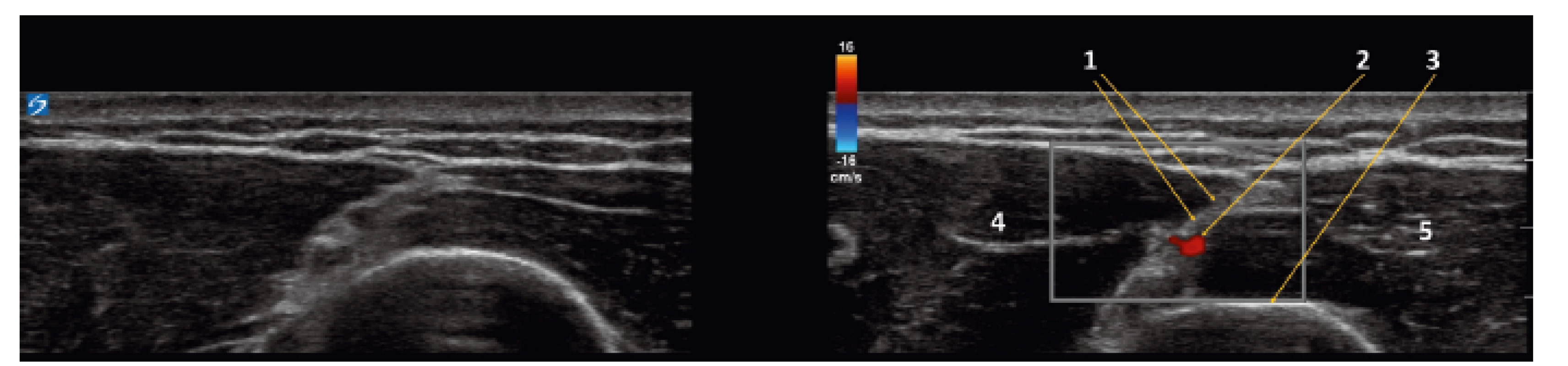 UZ obraz (colour doppler) zadní střední části paže<br>
1 – n. radialis po rozdělení na povrchní a hlubokou větev, 2 – a. brachii profunda, 3 – humerus, 4 – střední hlava m. triceps, 5 – laterální
hlava tricepsu