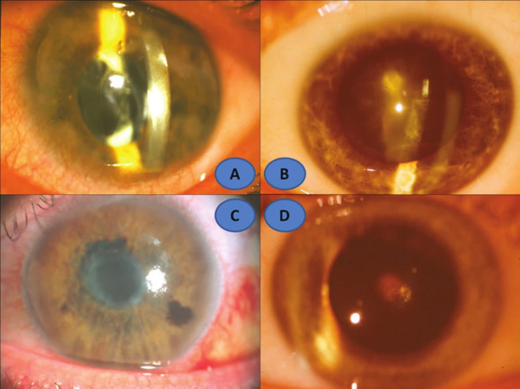 Clinical picture of anterior segment of sympathising eye: 16 year old consulted patient
(A), patient no. 3 (B), patient no. 5 (D), patient no. 6 (C)