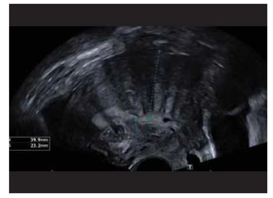 Difúzní děložní adenomyóza.<br>
Fig. 1. Diffuse uterine adenomyosis.