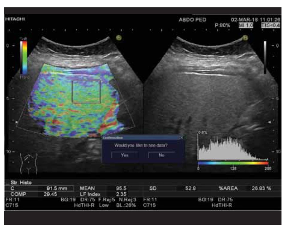 Stanovenie liver fibrosis indexu (LFI 2,35) pomocou real-time elastografie
u pacienta so signifikantnou steatózou pečene (HRI 1,85).<br>
Fig. 2. Determination of liver fibrosis index (LFI 2,35) by real-time elastography
in a patient with significant hepatic steatosis (HRI 1,85).