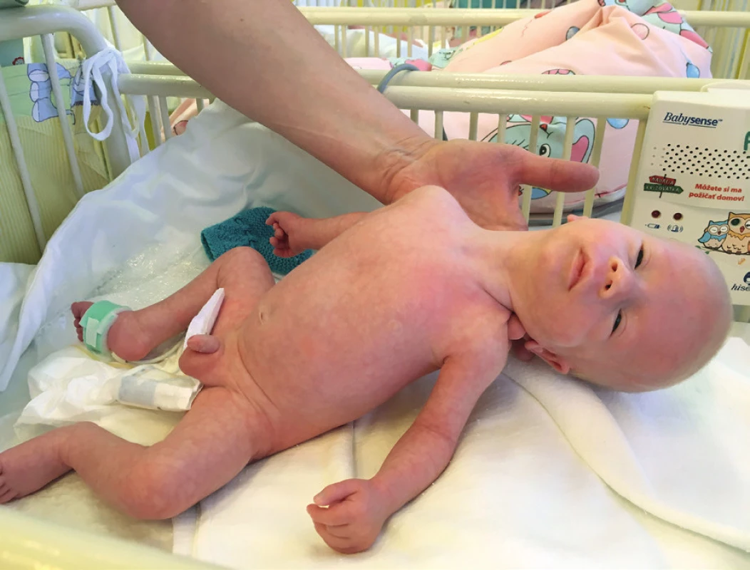 Ťažký centrálny hypotonus u novorodenca
s Praderovej-Williho syndrómom.<br>
Fig. 2. Severe central hypotonus in newborn with Prader-Willi
syndrome.
