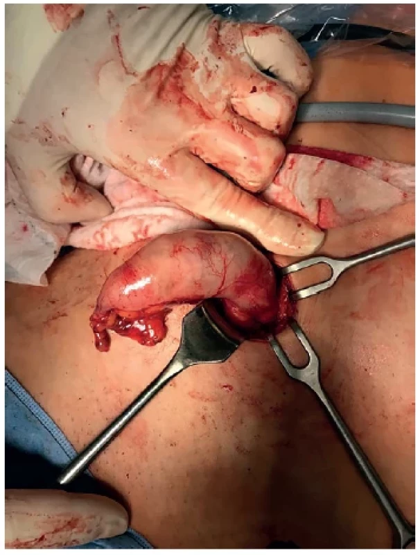 Mukokéla appendixu – náhodný nález při apendektomii
pro suspektní akutní apendicitidu <br> 
Fig. 2. Mucocoele of the appendix – an incidental finding
during appendectomy for suspected acute appendicitis