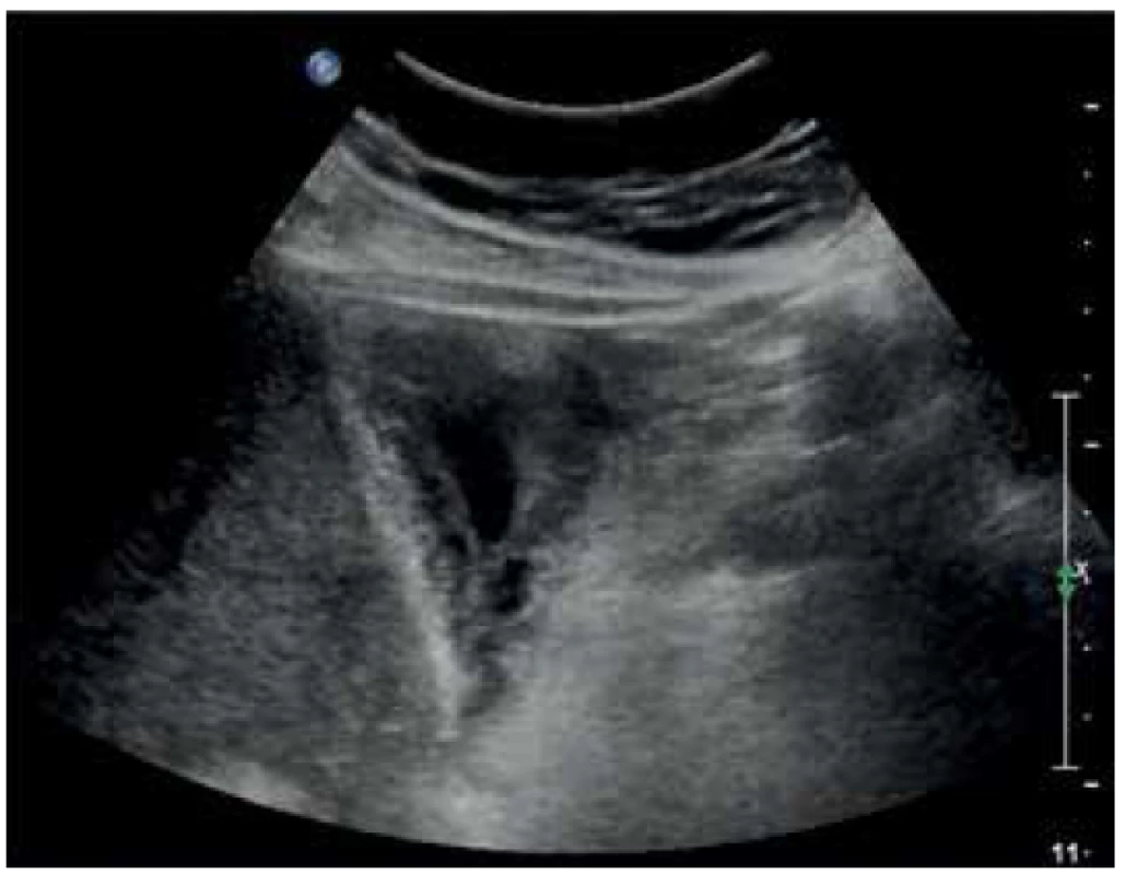 Zesílená stěna žlučníku na 14 mm v rámci akutní
cholecystitidy<br>
Fig. 6. Gallbladder wall thickened to 14 mm in acute cholecystitis