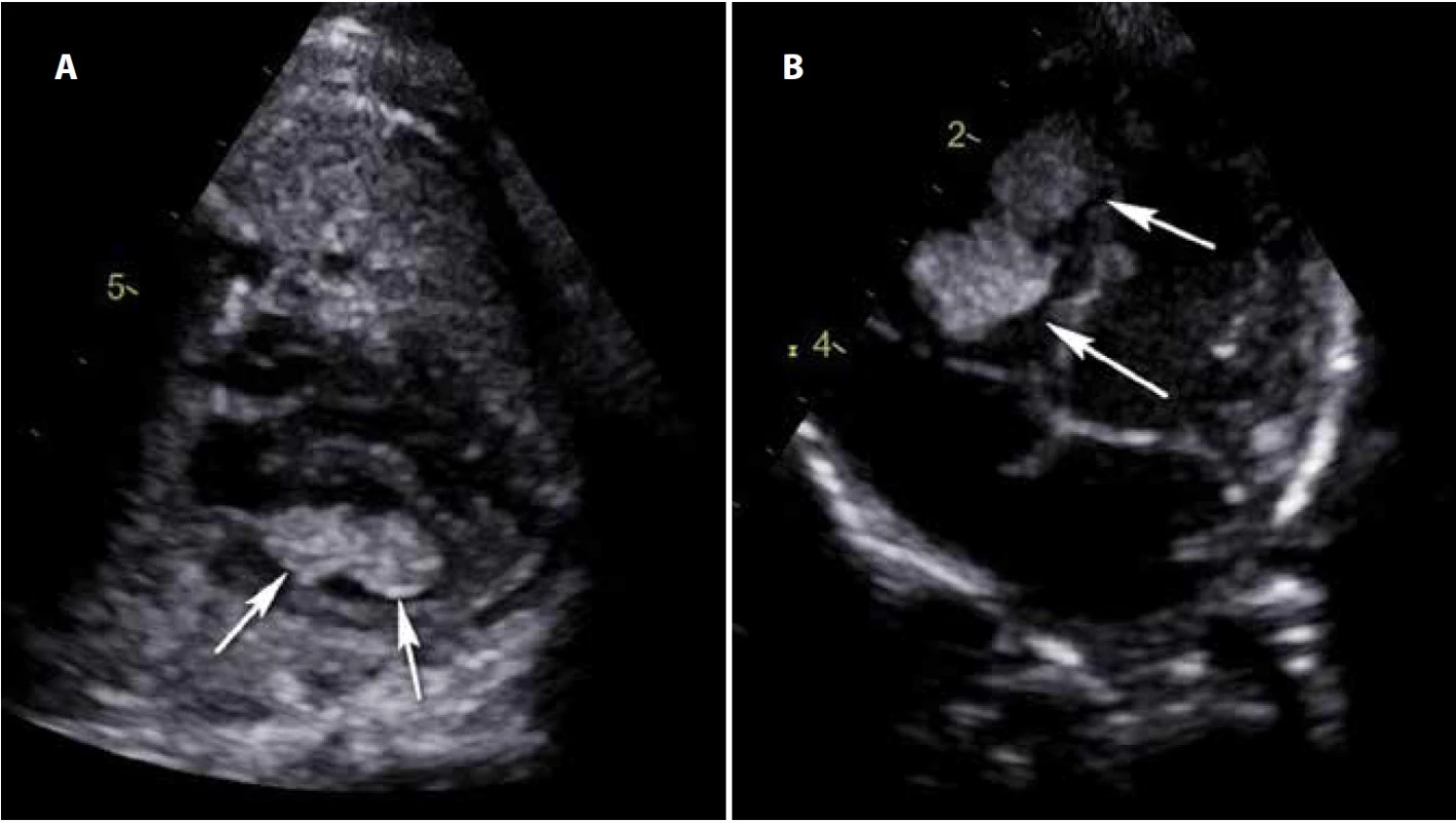 Rhabdomyom, echokardiografie, fetální (a) a postnatální (b) nález.<br>
Fig. 2. Rhabdomyoma, echocardiography, fetal (a), and postnatal (b) findings.