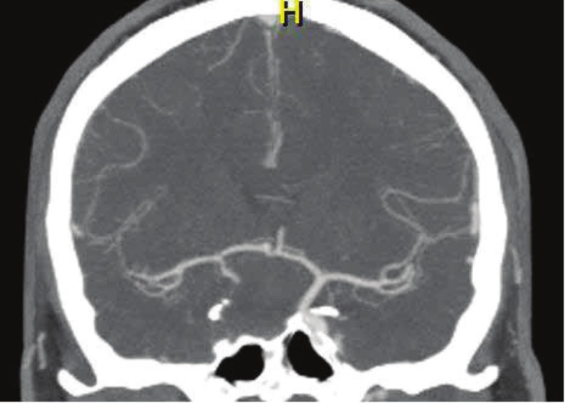 Angiographic examination one month after ligation
of the affected ACI. Retrograde filling of the aneurysm is
not evident.
