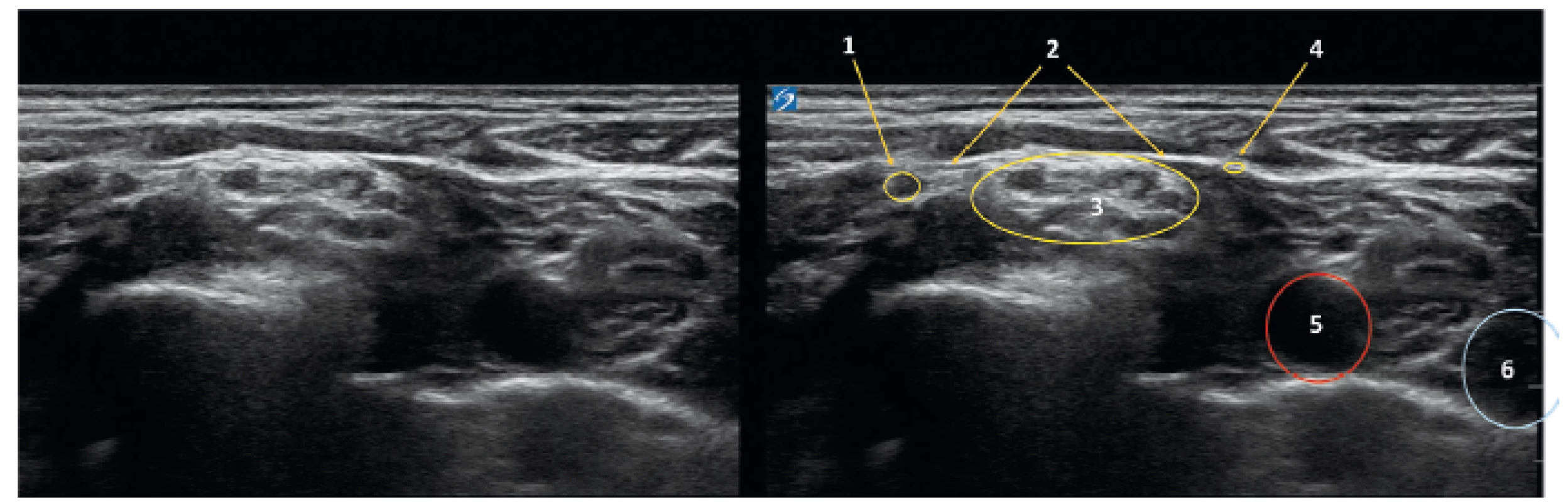 Ultrazvukový obraz krku v úrovni C 6.7
1 – levý supraskapulární nerv, 2 – fascie k m. omohyoideus, 3 – brachiální plexus, 4 – n. subclavius, 5 – arteria carotis, 6 – v. jugularis