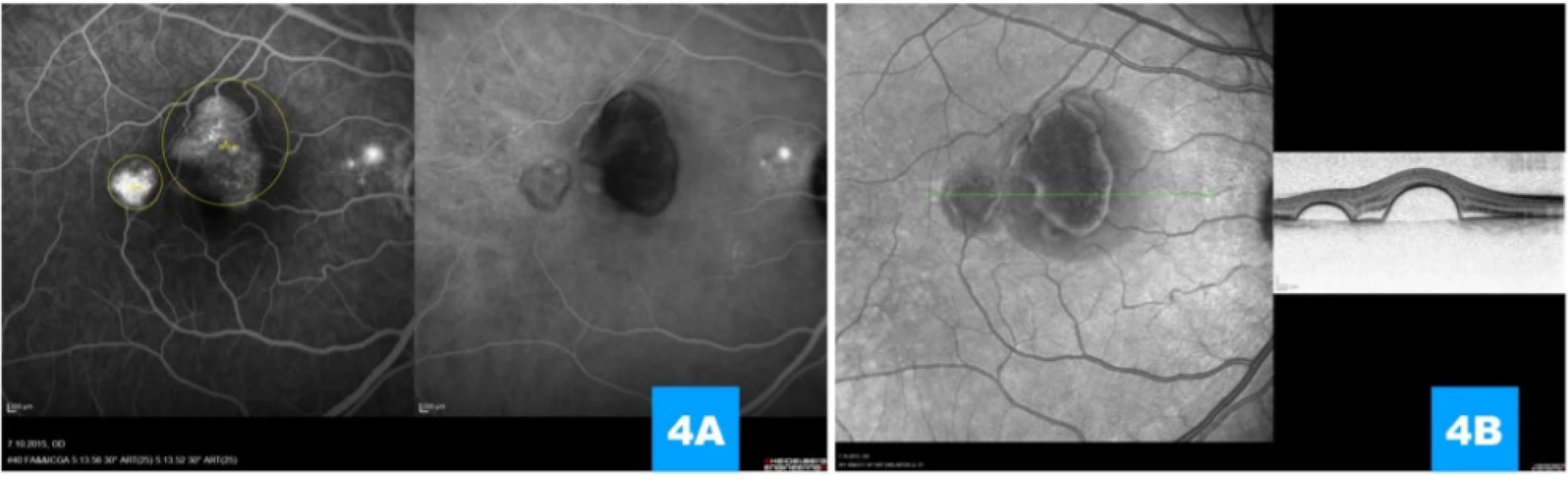  (A) Simultaneous image of fluorescence and indocyanine angiography illustrating late hyperfluorescence (pooling)
beneath ablations of the retinal pigment epithelium, minor deposit of hyperfluorescence in the parapapillary region, indication of size and location of beams for photodynamic therapy (yellow outlining); there is clear gradation of the filling of
the choroidea beneath serous ablations, at the same time the image excludes the presence of choroidal neovascularisation.